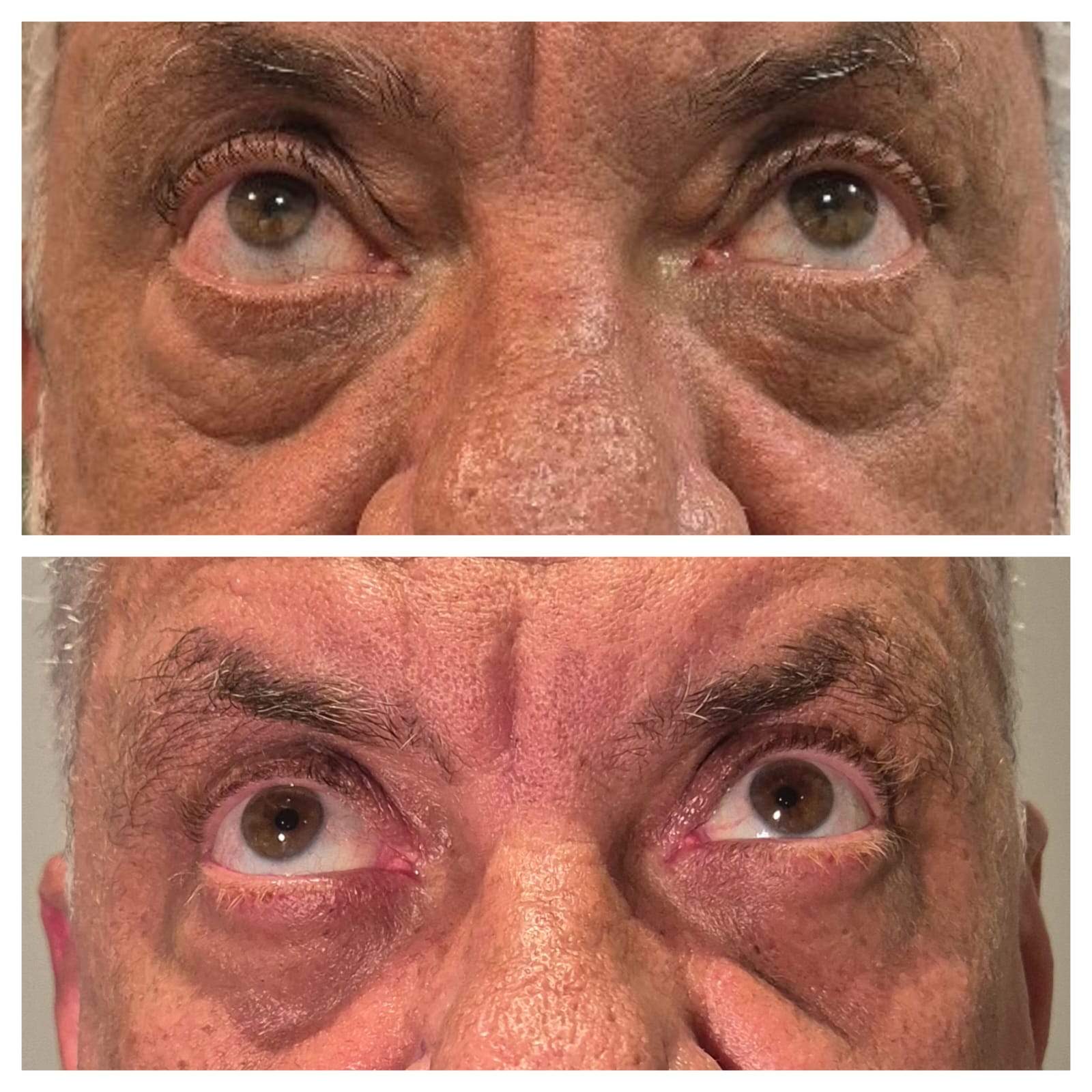 Antes e depois de blefaroplastia 12